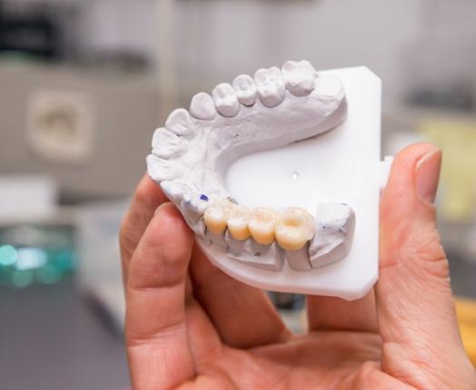 Model smile with dental bridge restoration