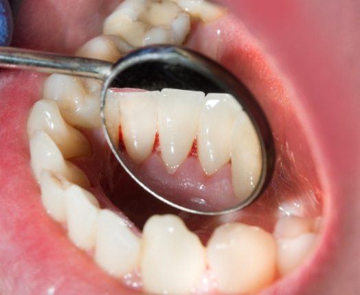 Closeup of smile showing some of the common risk factors for oral cancer