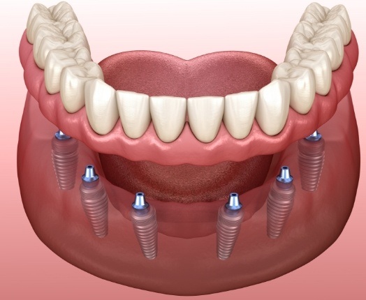 Animated dental implant supported denture placement