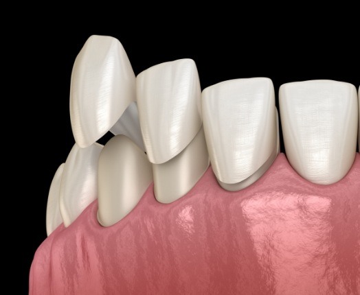 Animated smile during veneer placement