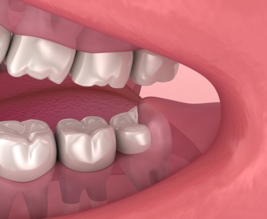 Animated smile with impacted bottom wisdom tooth