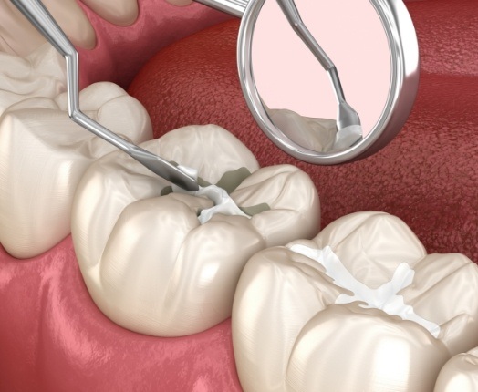 Animated smile during tooth colored filling placement