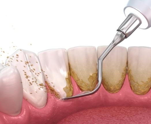 Animated smile during periodontal disease treatment