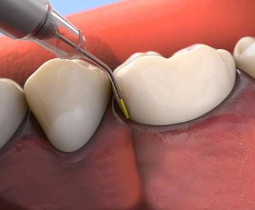 Animated smile during Arestin antibiotic treatment