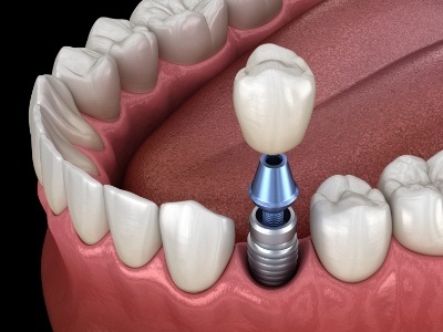 Animated smile during dental implant supported dental crown placement