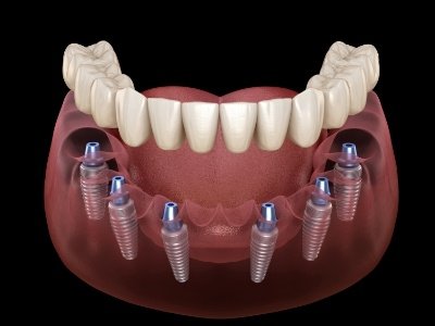 Animated smile during dental implant supported denture placement