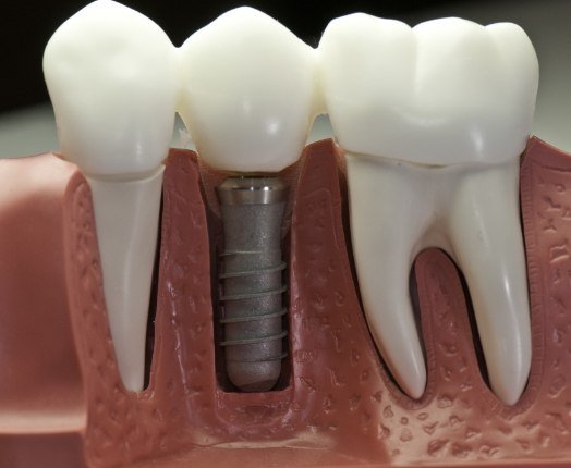 Model smile with dental implant supported dental crown