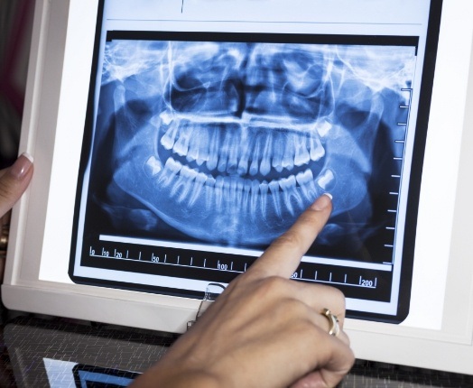 Digital dental x-rays on tablet computer