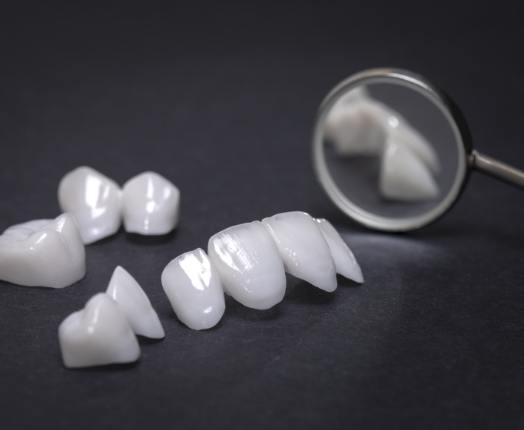 Different types of dental restorations including Lumineers