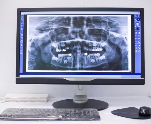 Digital dental x-rays on chairside computer screen