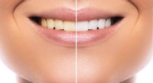 Get a bright smile with at-home teeth whitening in Harker Heights.