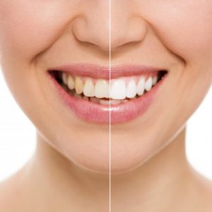 teeth whitening from dentist in Harker Heights